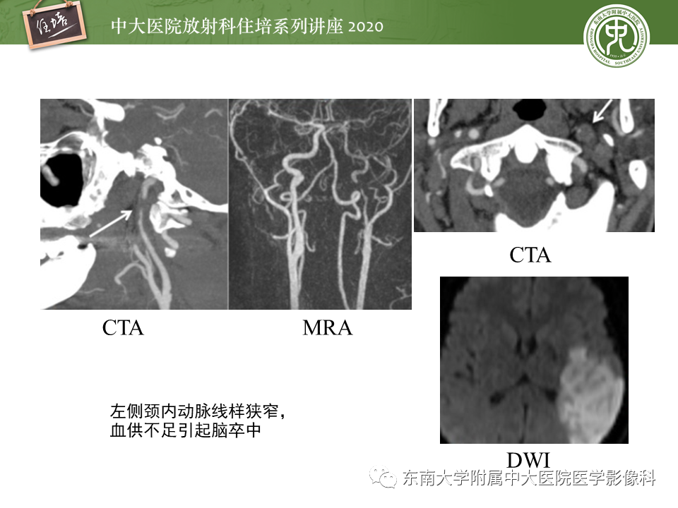 影像PPT - 【PPT】颈动脉夹层及夹层动脉瘤的影像诊断及评估-23