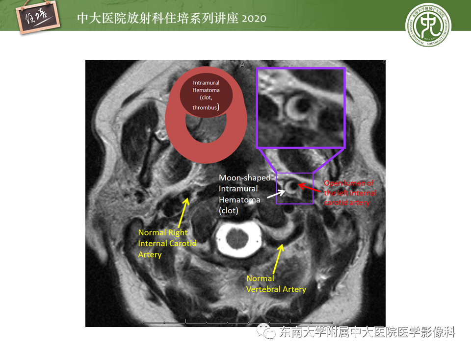 影像PPT - 【PPT】颈动脉夹层及夹层动脉瘤的影像诊断及评估-25