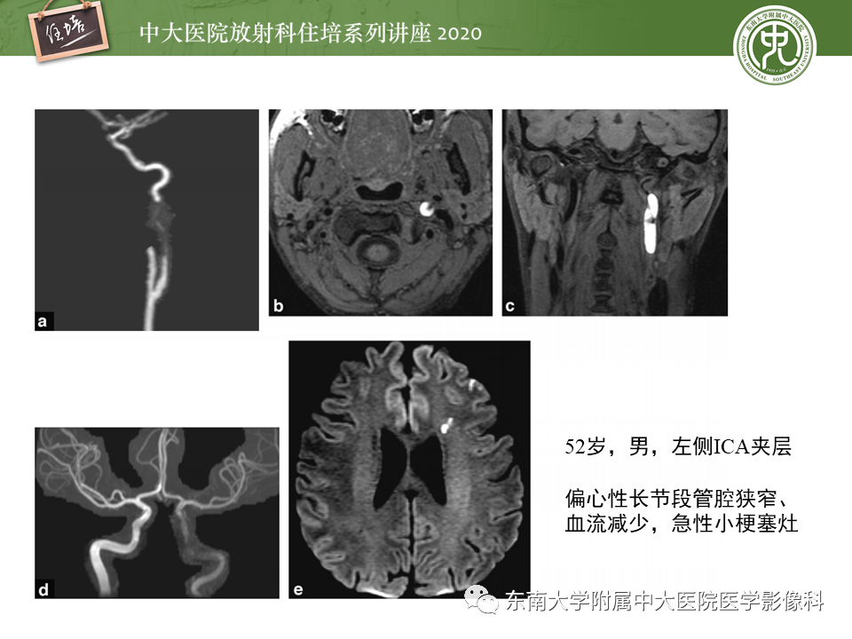 影像PPT - 【PPT】颈动脉夹层及夹层动脉瘤的影像诊断及评估-26