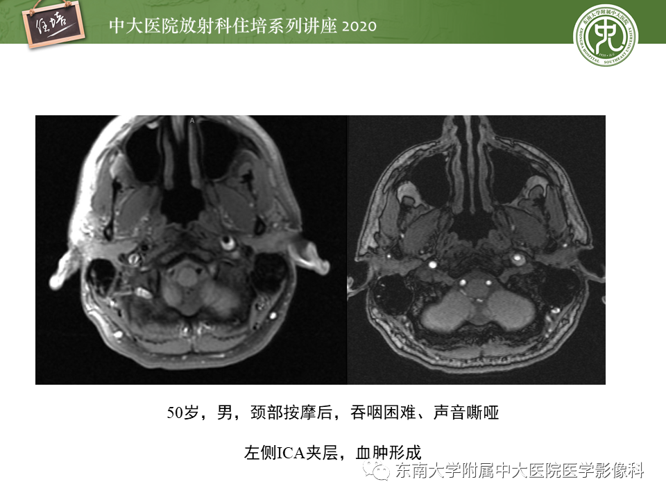 影像PPT - 【PPT】颈动脉夹层及夹层动脉瘤的影像诊断及评估-27