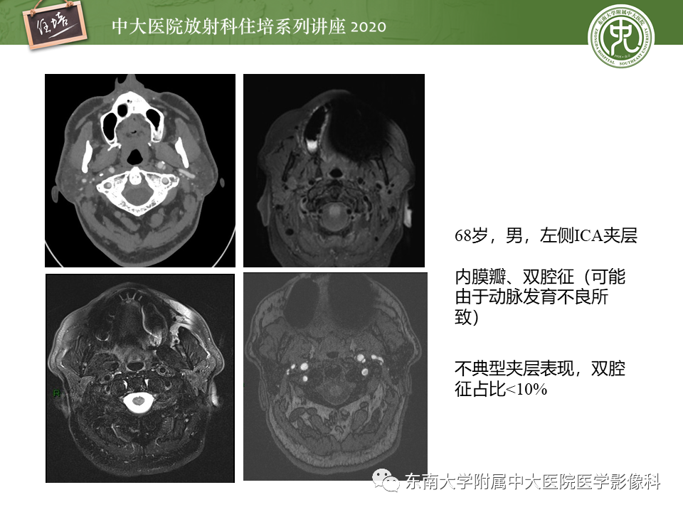影像PPT - 【PPT】颈动脉夹层及夹层动脉瘤的影像诊断及评估-28