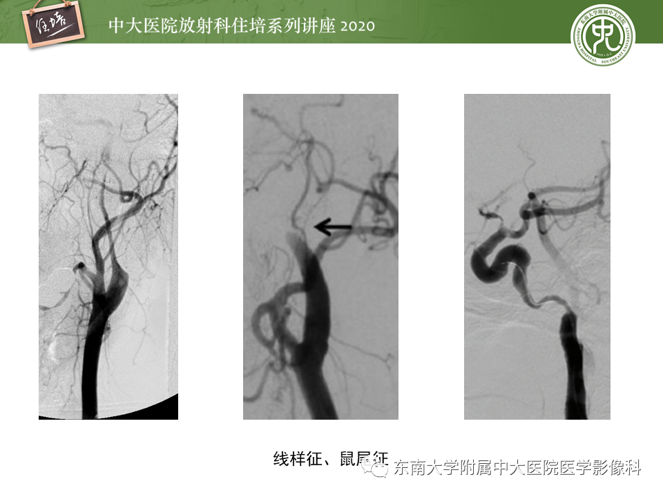影像PPT - 【PPT】颈动脉夹层及夹层动脉瘤的影像诊断及评估-30