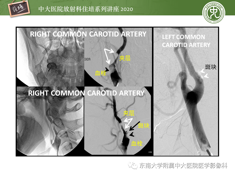 影像PPT - 【PPT】颈动脉夹层及夹层动脉瘤的影像诊断及评估-31