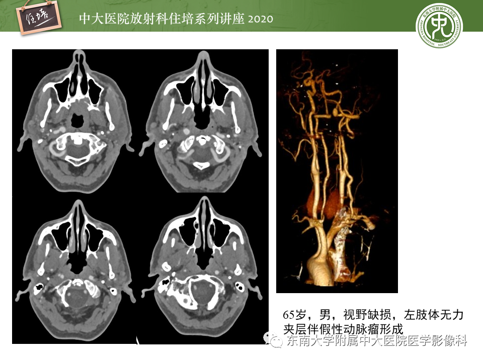 影像PPT - 【PPT】颈动脉夹层及夹层动脉瘤的影像诊断及评估-33