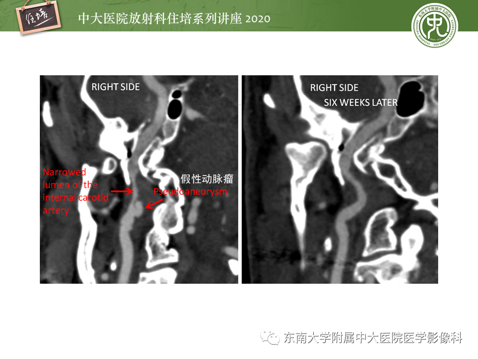 影像PPT - 【PPT】颈动脉夹层及夹层动脉瘤的影像诊断及评估-34