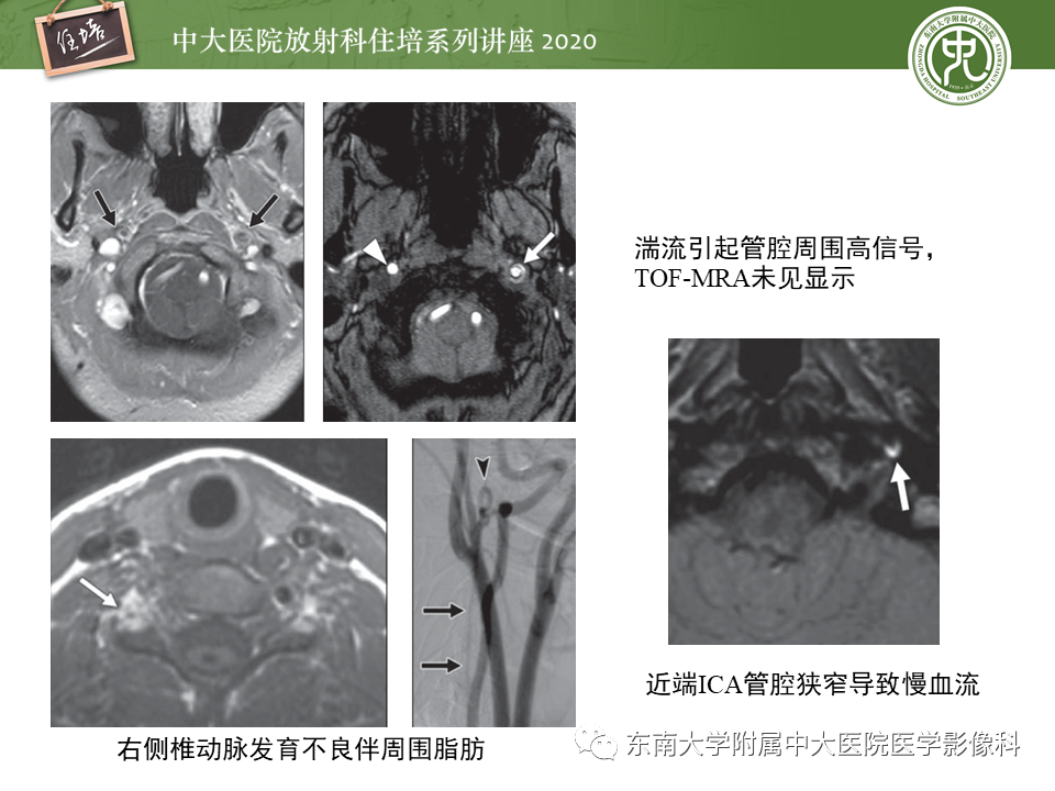 影像PPT - 【PPT】颈动脉夹层及夹层动脉瘤的影像诊断及评估-37