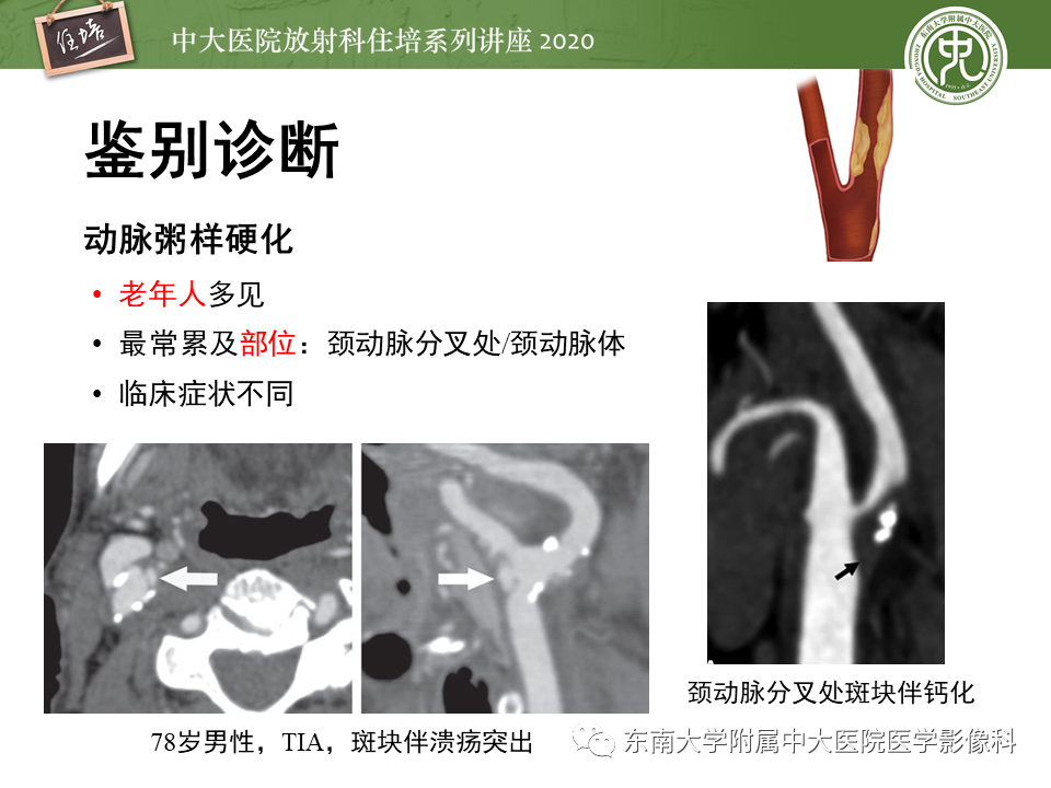 影像PPT - 【PPT】颈动脉夹层及夹层动脉瘤的影像诊断及评估-40