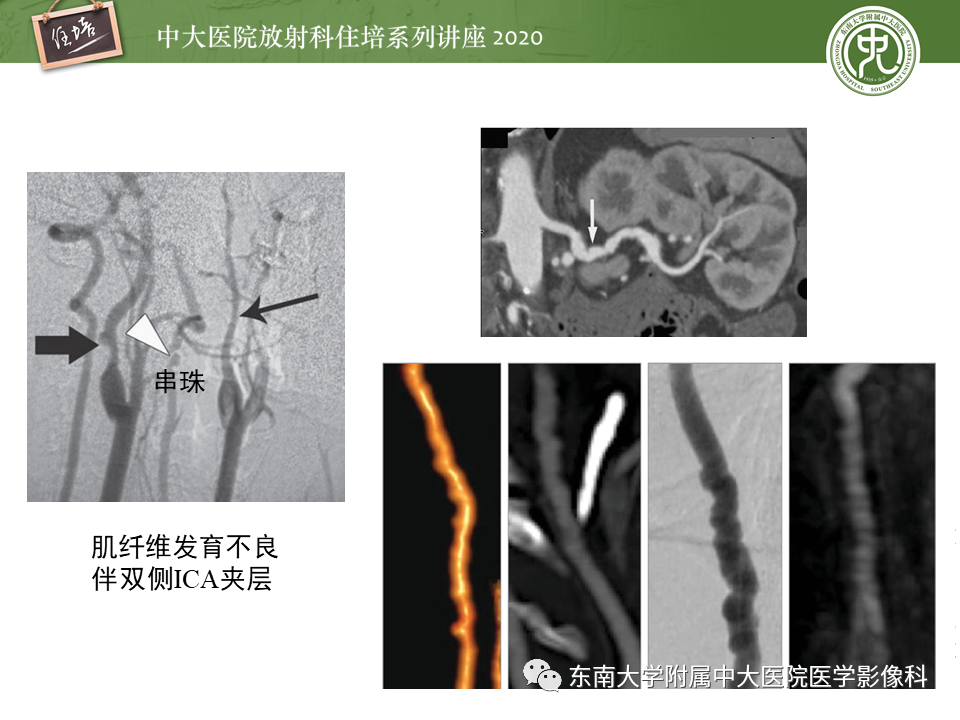 影像PPT - 【PPT】颈动脉夹层及夹层动脉瘤的影像诊断及评估-42