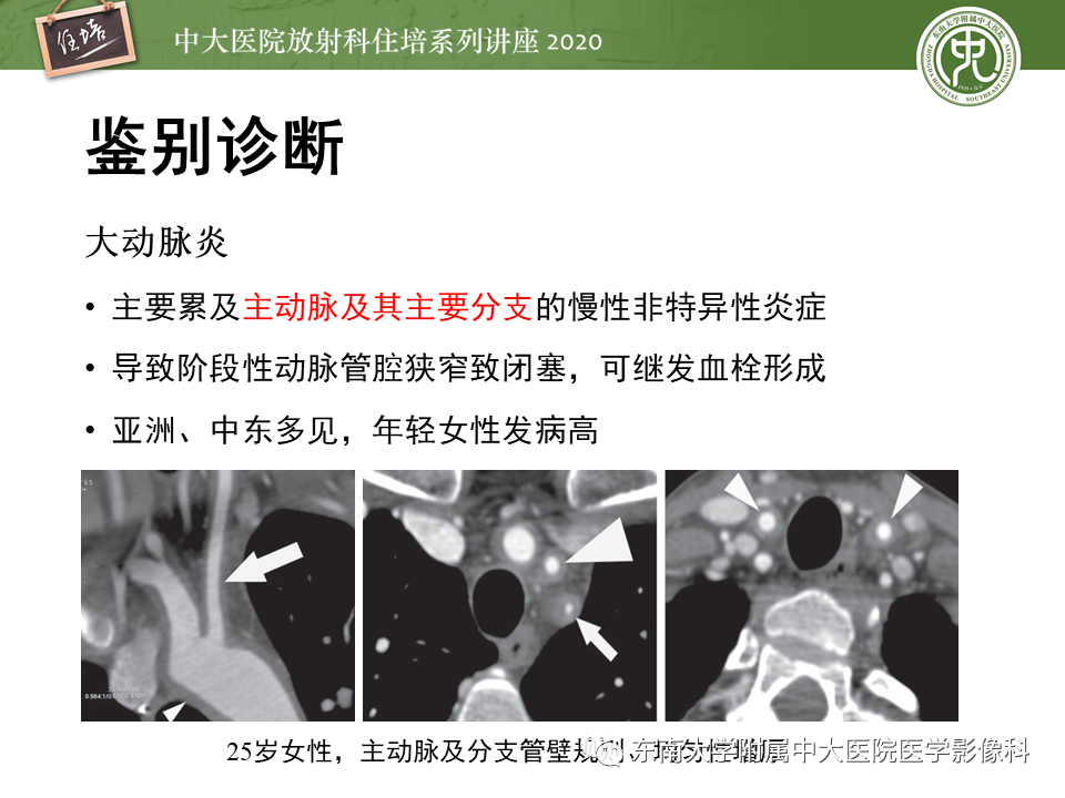影像PPT - 【PPT】颈动脉夹层及夹层动脉瘤的影像诊断及评估-43