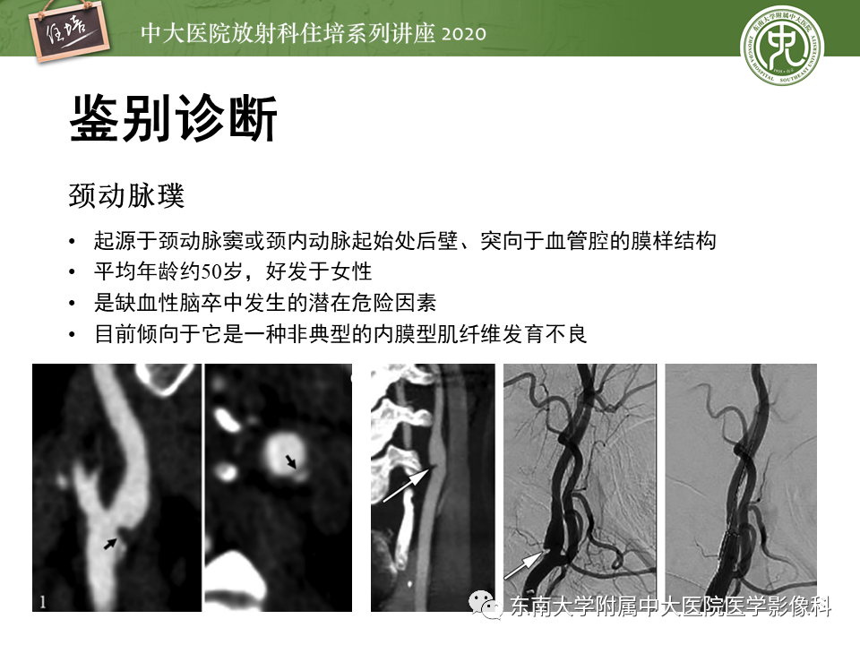 影像PPT - 【PPT】颈动脉夹层及夹层动脉瘤的影像诊断及评估-44