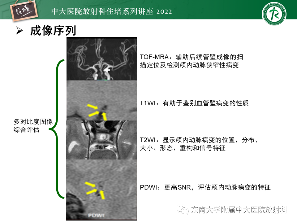 影像PPT - 【PPT】颅内MR血管壁成像技术与应用专家共识解读-13