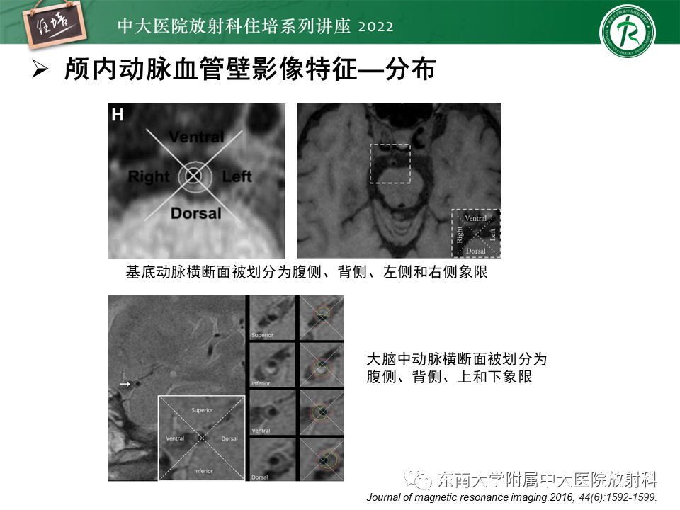 影像PPT - 【PPT】颅内MR血管壁成像技术与应用专家共识解读-22