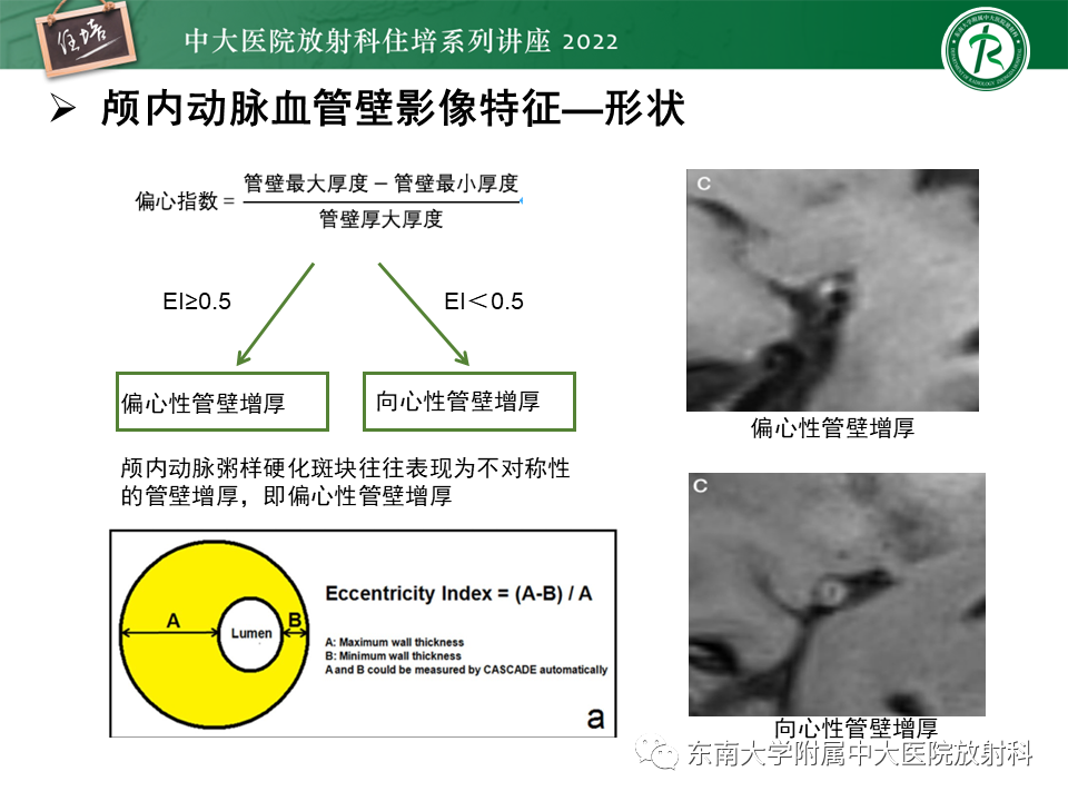 影像PPT - 【PPT】颅内MR血管壁成像技术与应用专家共识解读-23
