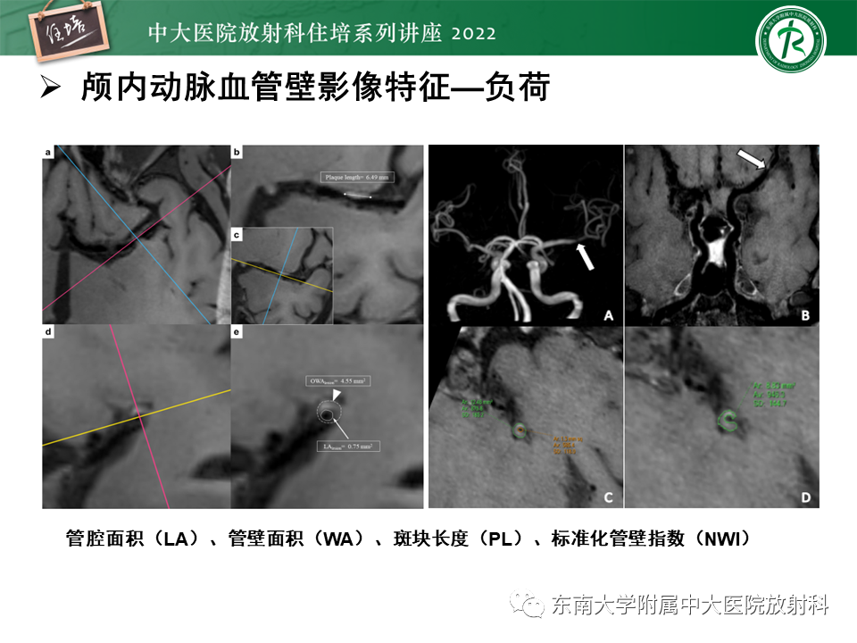影像PPT - 【PPT】颅内MR血管壁成像技术与应用专家共识解读-24