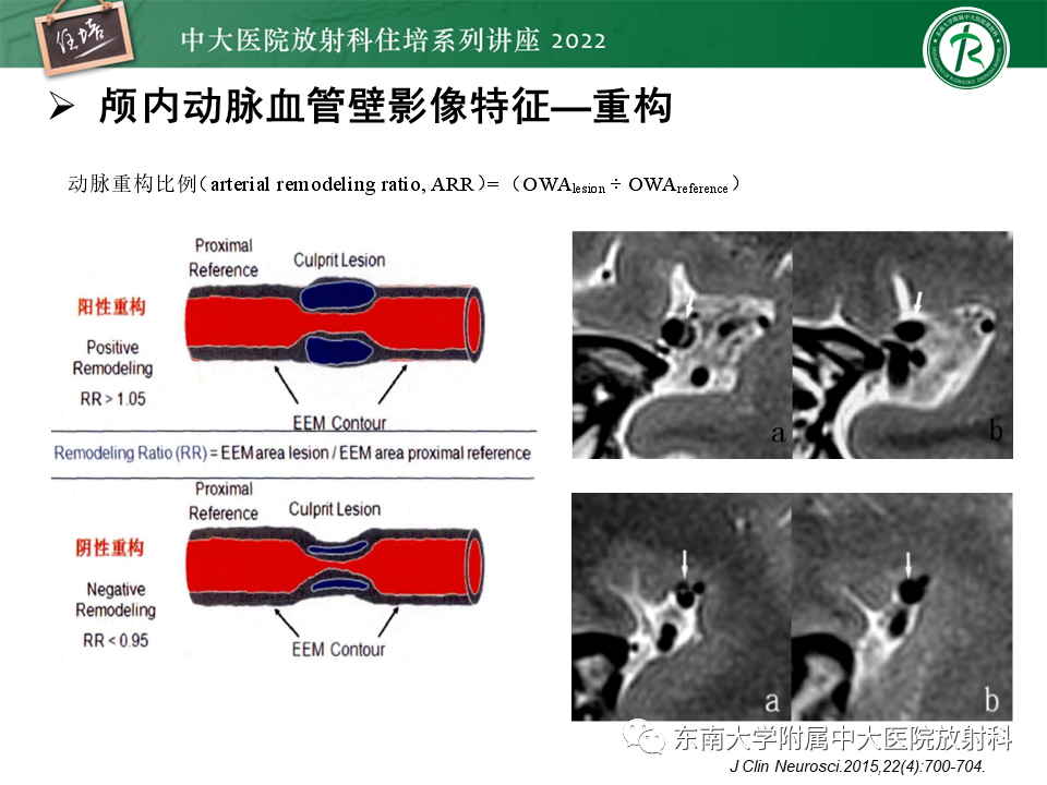 影像PPT - 【PPT】颅内MR血管壁成像技术与应用专家共识解读-25