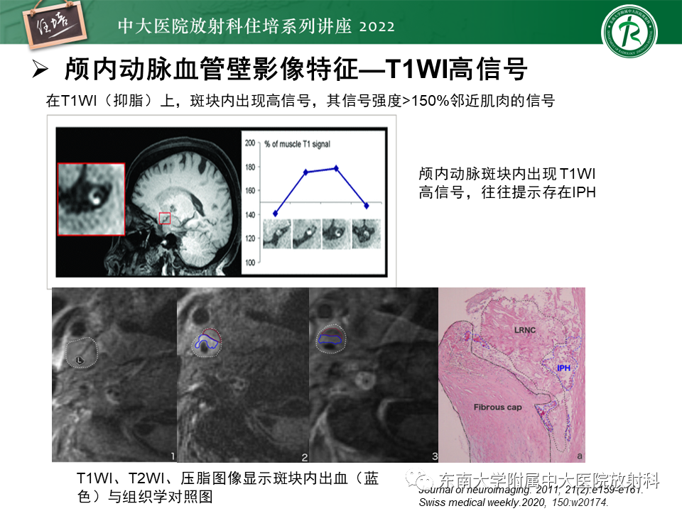 影像PPT - 【PPT】颅内MR血管壁成像技术与应用专家共识解读-26