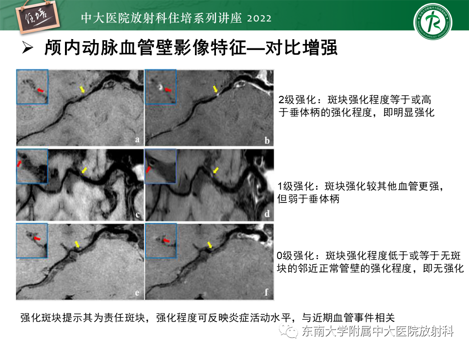 影像PPT - 【PPT】颅内MR血管壁成像技术与应用专家共识解读-27