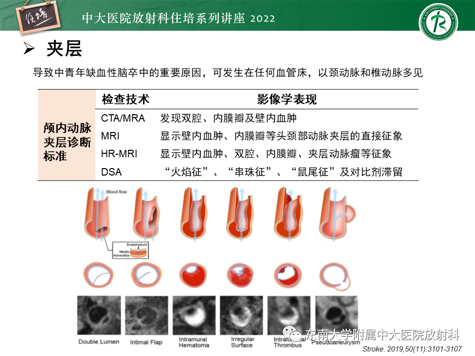 影像PPT - 【PPT】颅内MR血管壁成像技术与应用专家共识解读-33