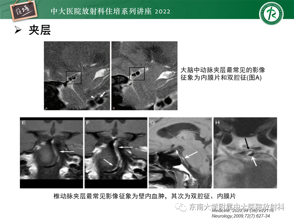 影像PPT - 【PPT】颅内MR血管壁成像技术与应用专家共识解读-34