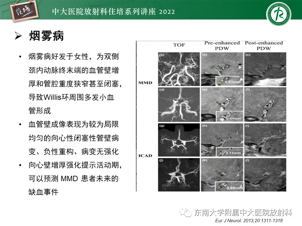 影像PPT - 【PPT】颅内MR血管壁成像技术与应用专家共识解读-36