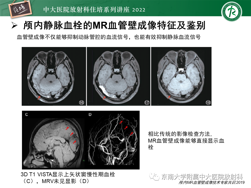 影像PPT - 【PPT】颅内MR血管壁成像技术与应用专家共识解读-40