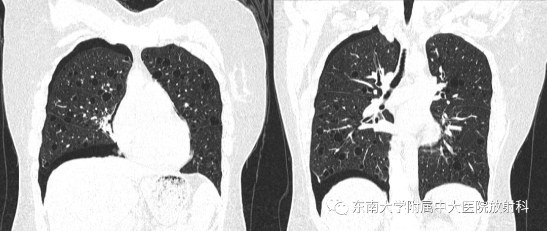 影像PPT - 【PPT】肺淋巴管肌瘤病-2
