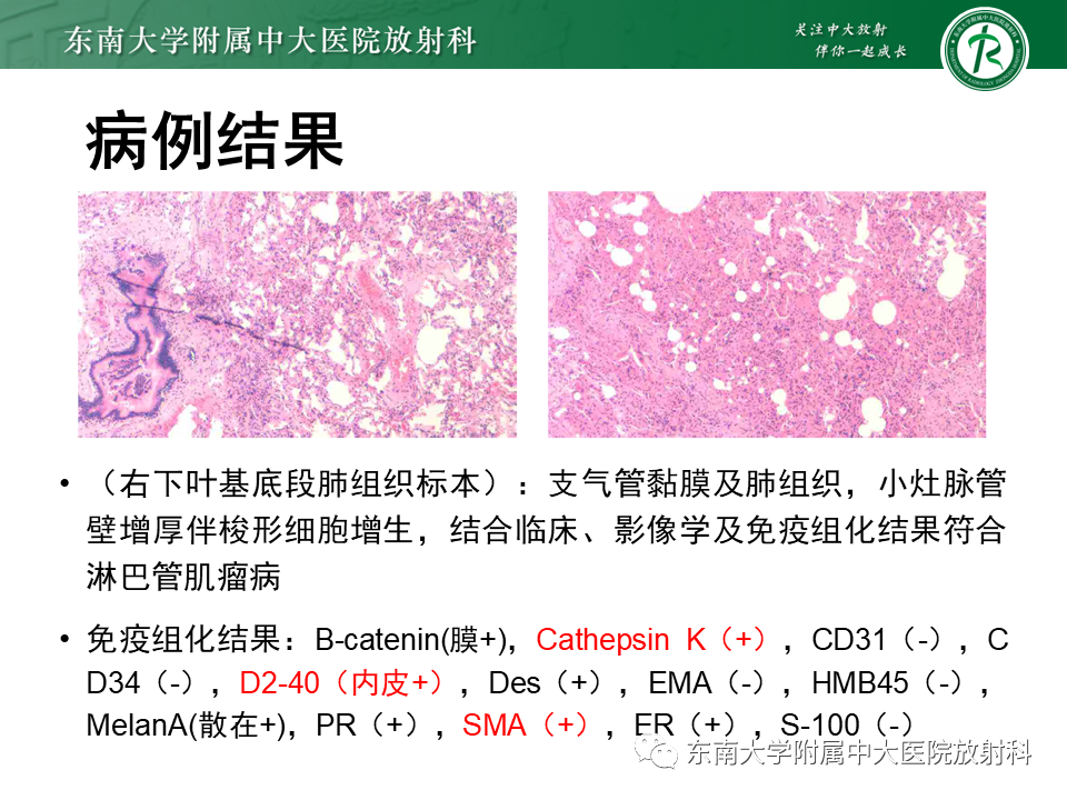 影像PPT - 【PPT】肺淋巴管肌瘤病-3