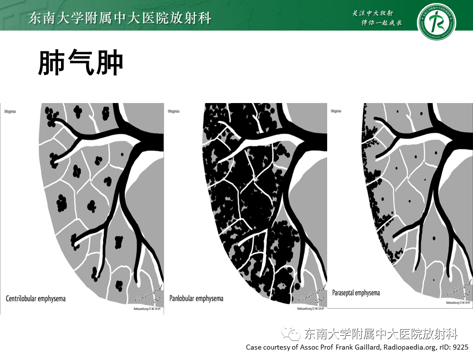 影像PPT - 【PPT】肺淋巴管肌瘤病-7