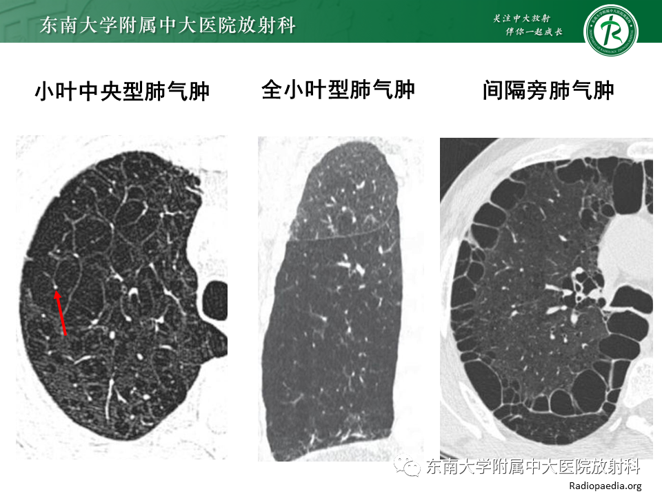 影像PPT - 【PPT】肺淋巴管肌瘤病-8