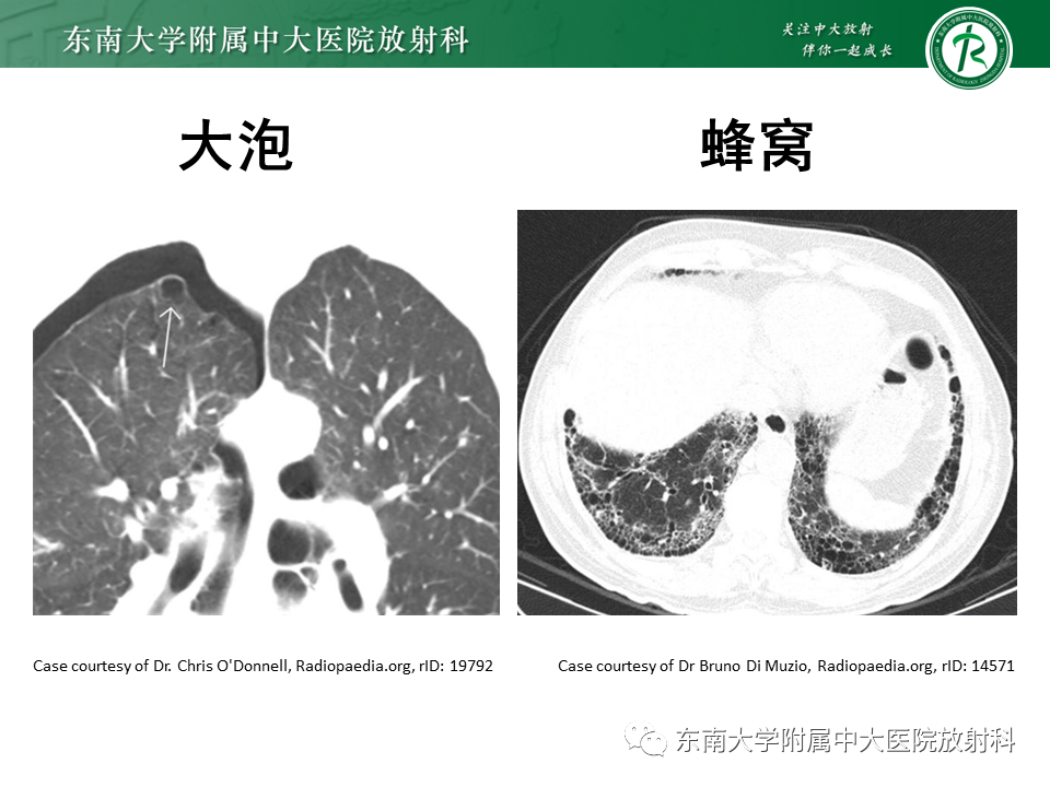 影像PPT - 【PPT】肺淋巴管肌瘤病-10