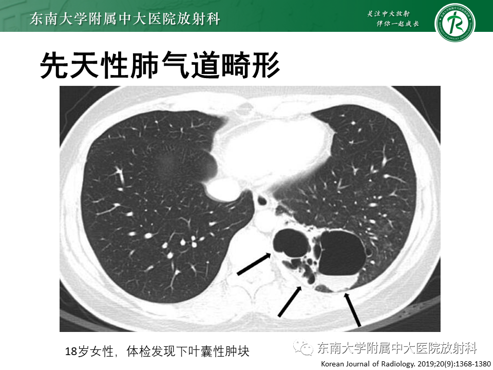 影像PPT - 【PPT】肺淋巴管肌瘤病-17