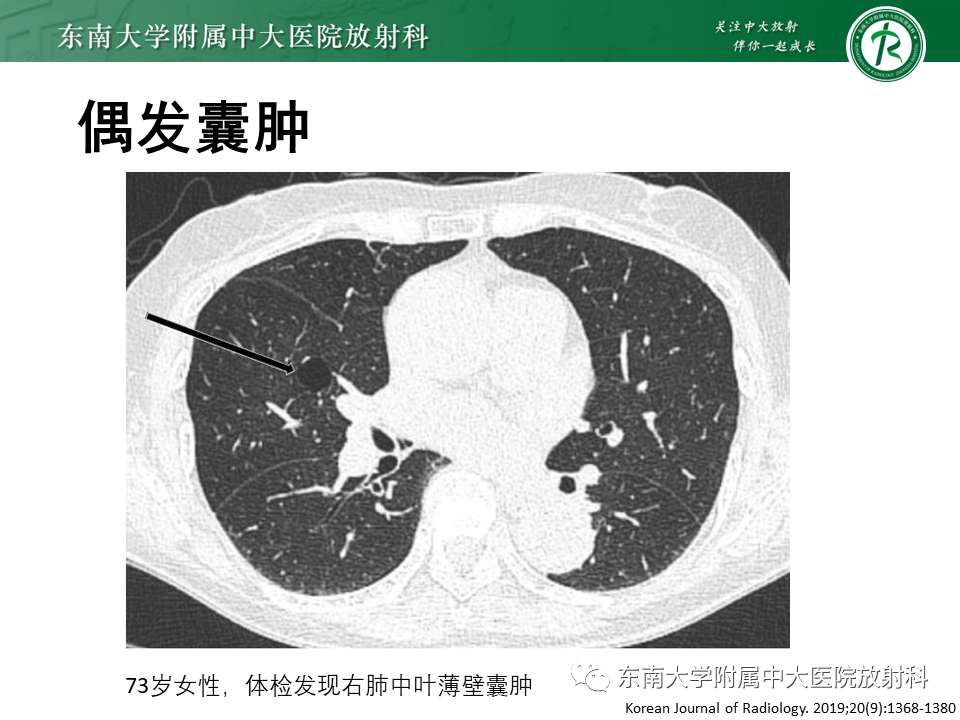 影像PPT - 【PPT】肺淋巴管肌瘤病-16