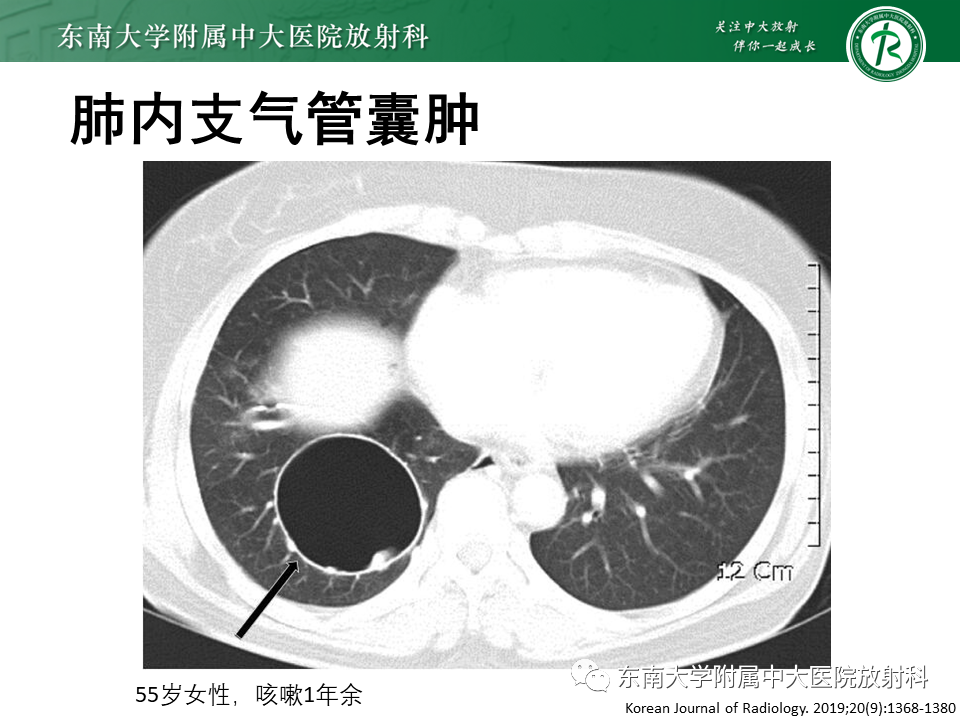影像PPT - 【PPT】肺淋巴管肌瘤病-18