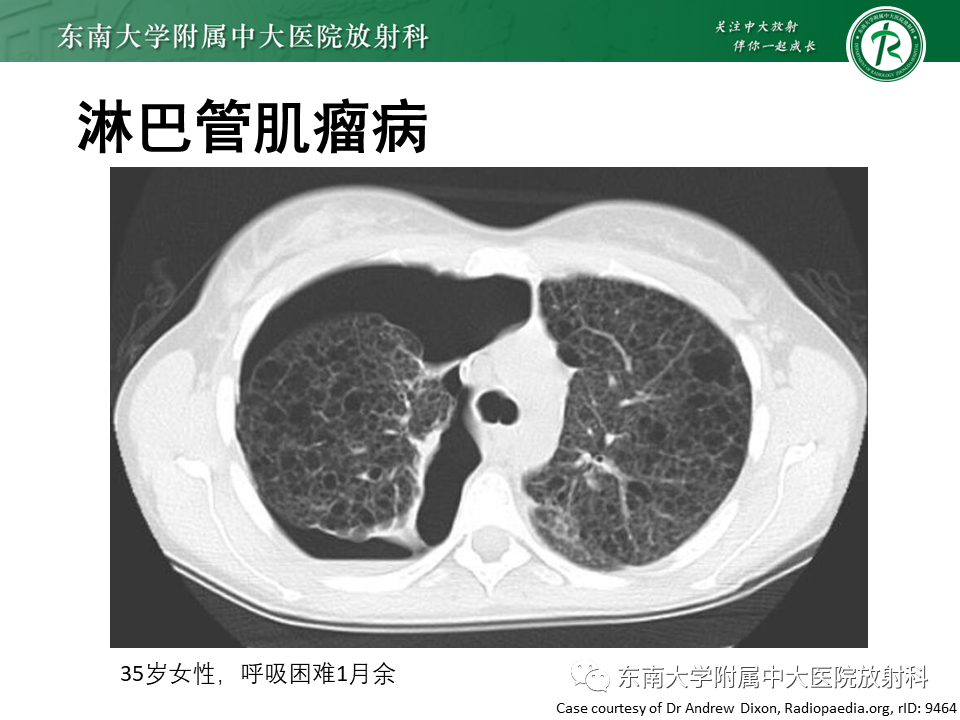 影像PPT - 【PPT】肺淋巴管肌瘤病-21