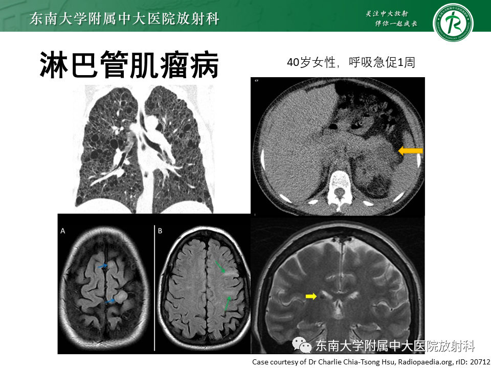 影像PPT - 【PPT】肺淋巴管肌瘤病-22