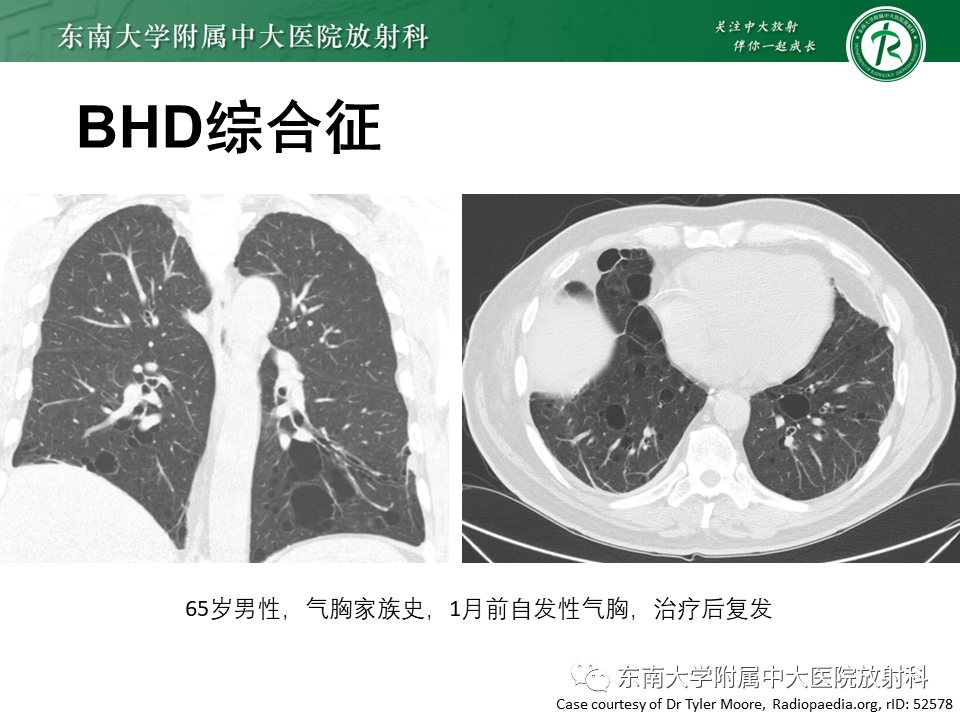 影像PPT - 【PPT】肺淋巴管肌瘤病-25