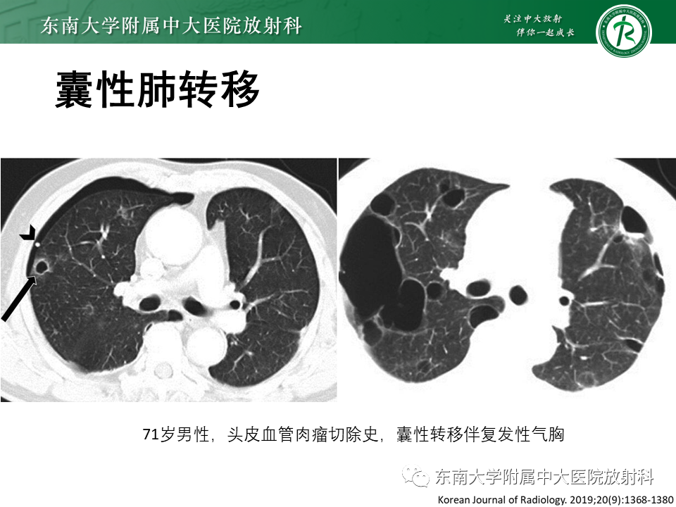 影像PPT - 【PPT】肺淋巴管肌瘤病-29