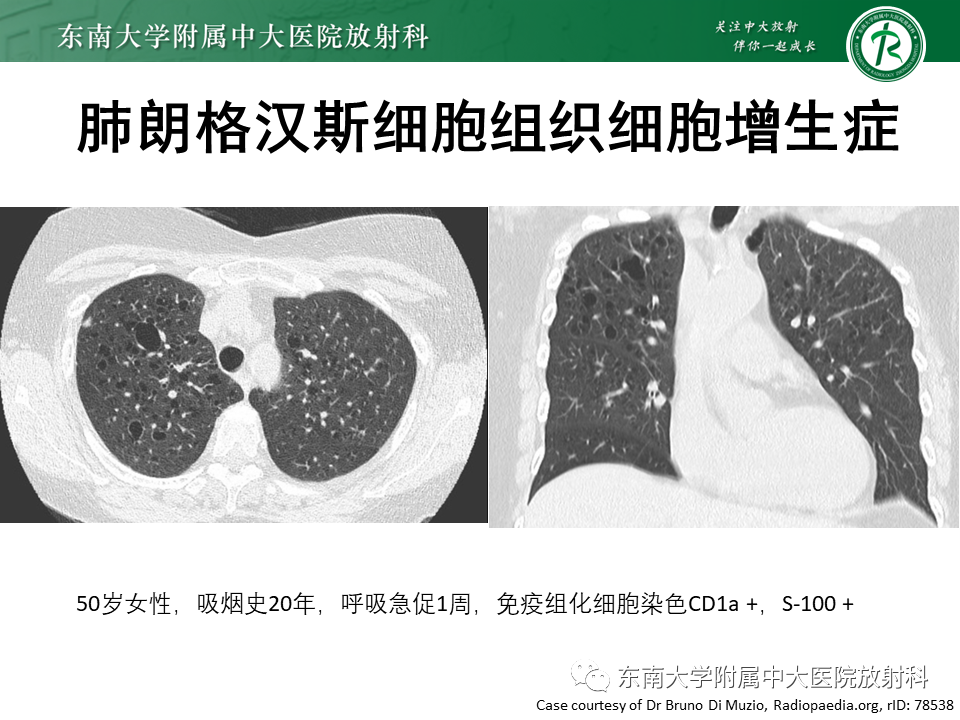 影像PPT - 【PPT】肺淋巴管肌瘤病-27
