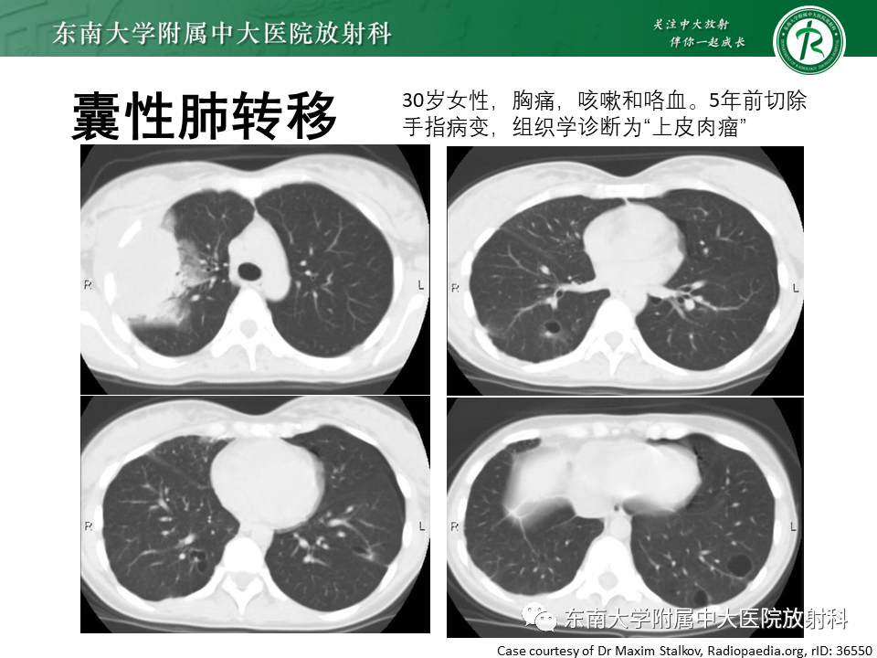 影像PPT - 【PPT】肺淋巴管肌瘤病-30