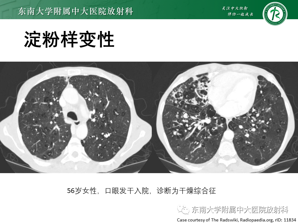 影像PPT - 【PPT】肺淋巴管肌瘤病-32