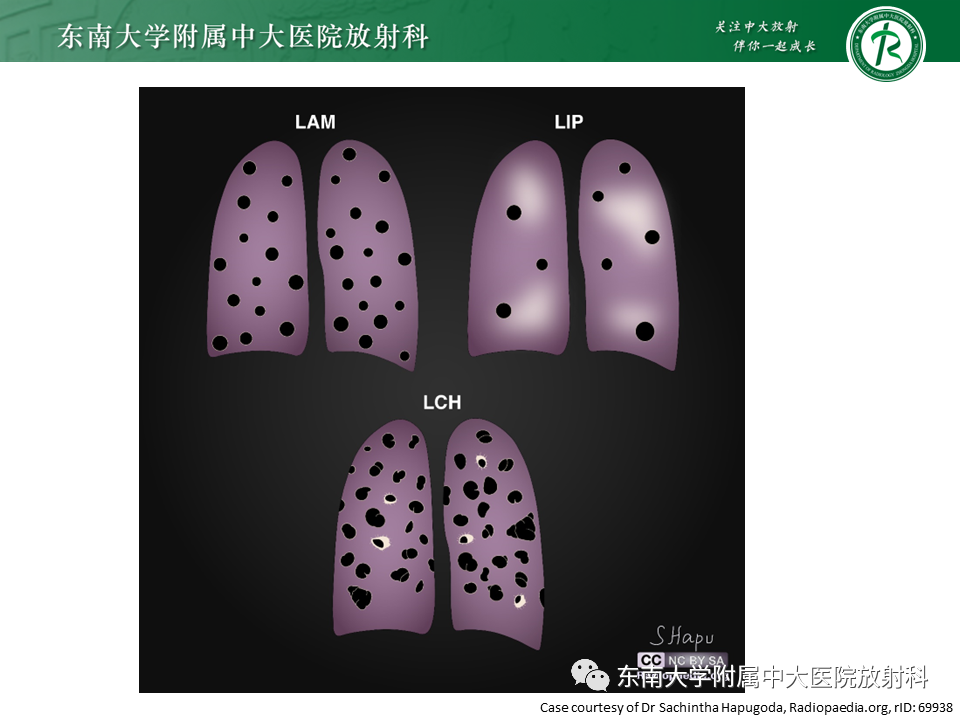 影像PPT - 【PPT】肺淋巴管肌瘤病-35