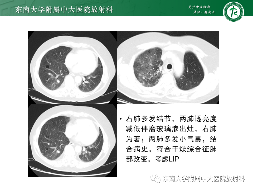 影像PPT - 【PPT】肺淋巴管肌瘤病-38
