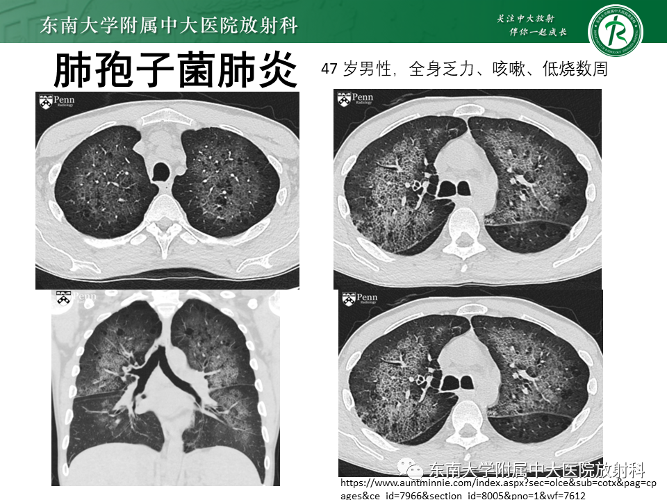 影像PPT - 【PPT】肺淋巴管肌瘤病-40