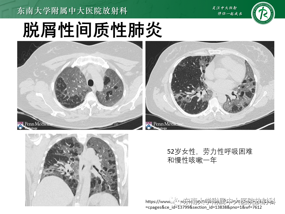 影像PPT - 【PPT】肺淋巴管肌瘤病-42