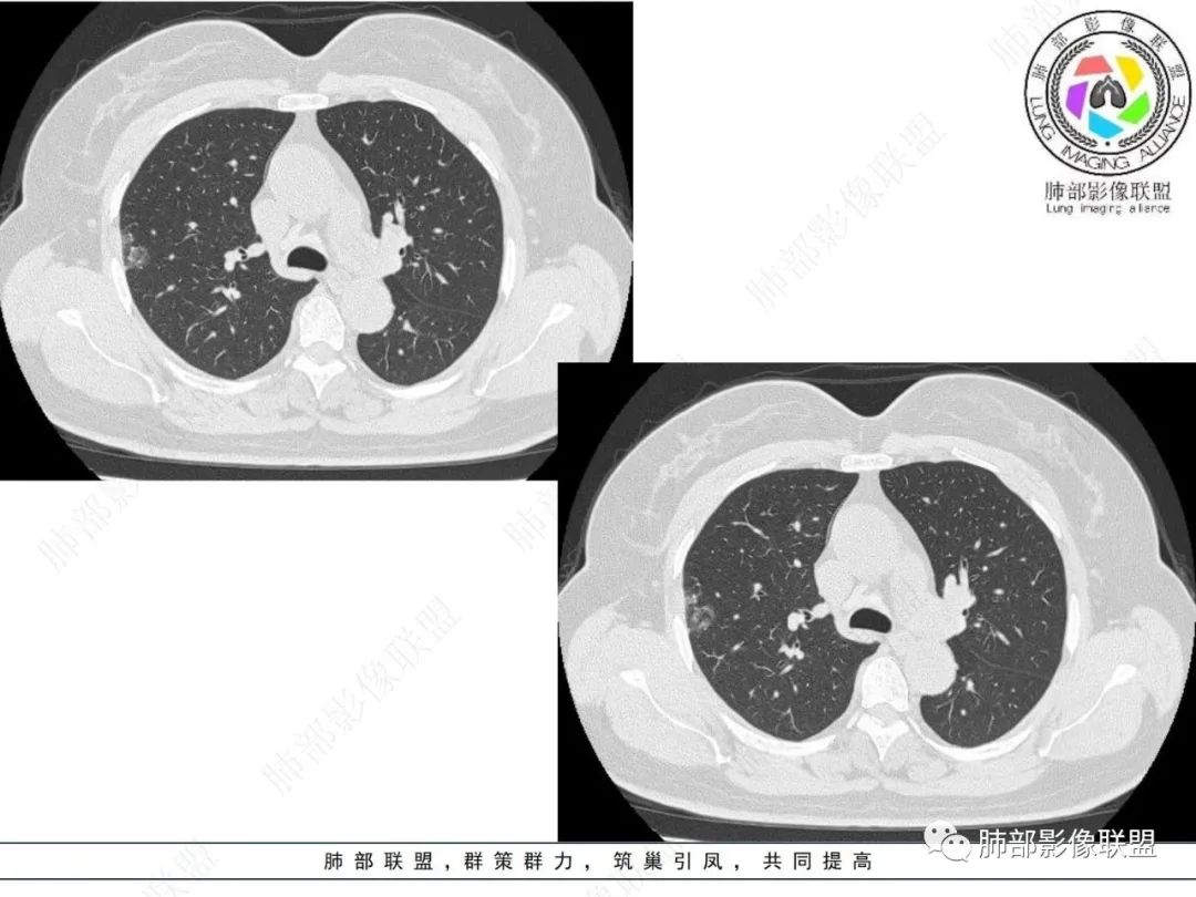 影像PPT - 【病例】粘液腺癌与隐球菌的鉴别诊断-3 影像PPT - 【病例】粘液腺癌与隐球菌的鉴别诊断-3
