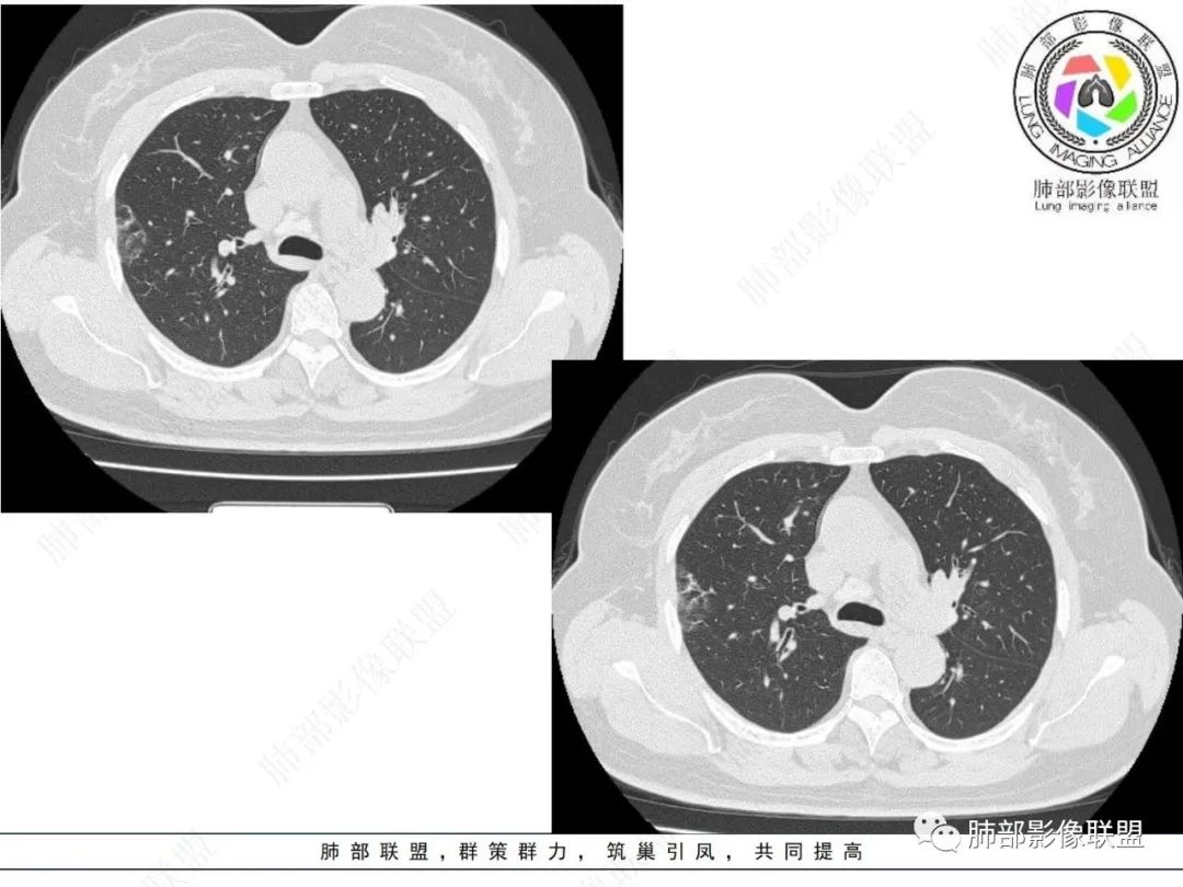影像PPT - 【病例】粘液腺癌与隐球菌的鉴别诊断-4 影像PPT - 【病例】粘液腺癌与隐球菌的鉴别诊断-4