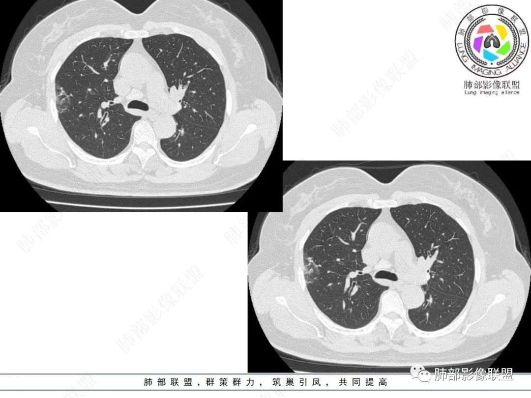 影像PPT - 【病例】粘液腺癌与隐球菌的鉴别诊断-5 影像PPT - 【病例】粘液腺癌与隐球菌的鉴别诊断-5