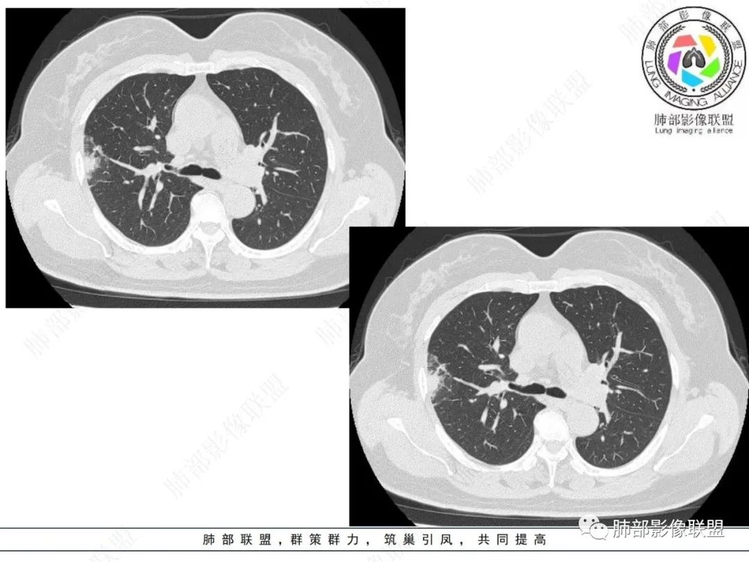 影像PPT - 【病例】粘液腺癌与隐球菌的鉴别诊断-7 影像PPT - 【病例】粘液腺癌与隐球菌的鉴别诊断-7