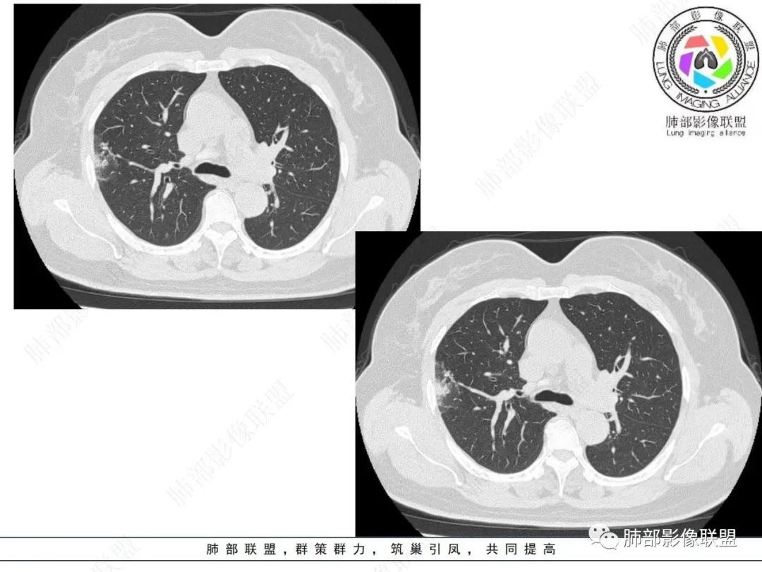 影像PPT - 【病例】粘液腺癌与隐球菌的鉴别诊断-6 影像PPT - 【病例】粘液腺癌与隐球菌的鉴别诊断-6