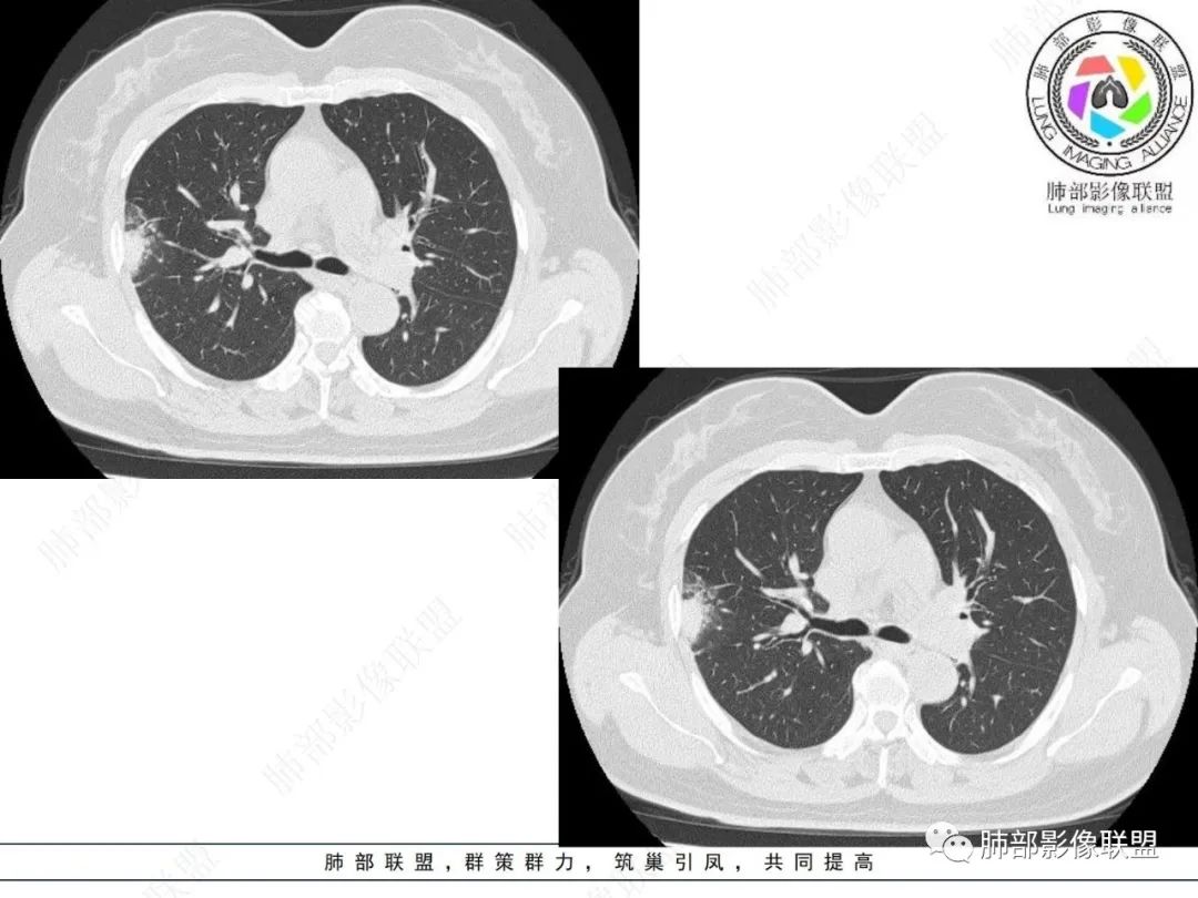影像PPT - 【病例】粘液腺癌与隐球菌的鉴别诊断-8 影像PPT - 【病例】粘液腺癌与隐球菌的鉴别诊断-8